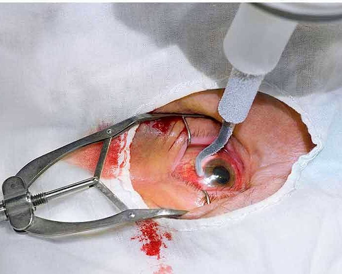 Carol Wehier 1998 yılında sağ gözünü aldırdığı ameliyat