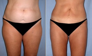 Liposuction hakkında merak edilenler