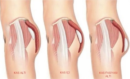 Popo Estetiği Nasıl Yapılır