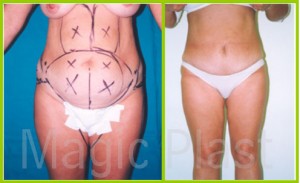 Karın Germe Estetik Ameliyatı