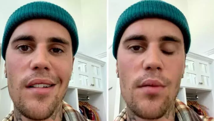 Justin Bieber yüz felci geçirdi
